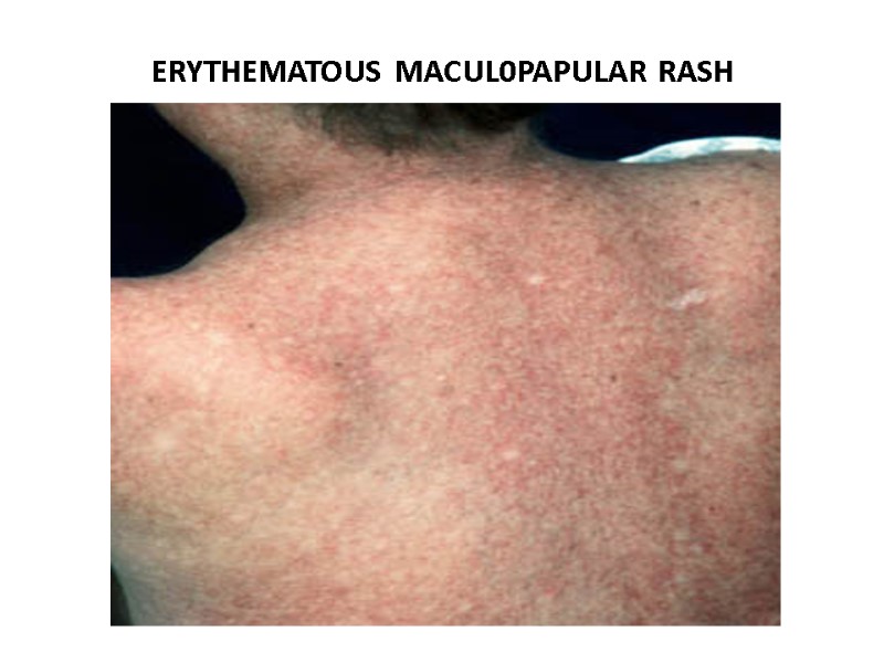 ERYTHEMATOUS MACUL0PAPULAR RASH